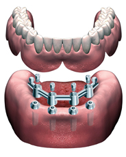overdenture toronto impianti dentali dentiera dentista odontoiatrici